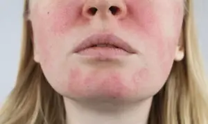 Czy kwas hialuronowy uczula? Prawdziwa alergia to mit! Sprawdź.