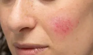 Cera naczynkowa: objawy, przyczyny, trądzik różowaty jak odróżnić?