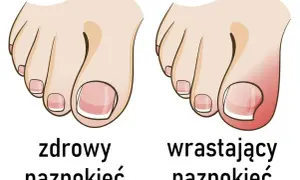 Jak prawidłowo obcinać paznokcie u stóp? Koniec z wrastaniem!