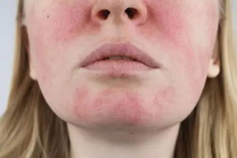 Czy kwas hialuronowy uczula? Prawdziwa alergia to mit! Sprawdź.