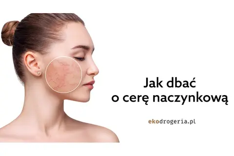 Jak dbać o cerę naczynkową? Skuteczne metody i porady eksperta
