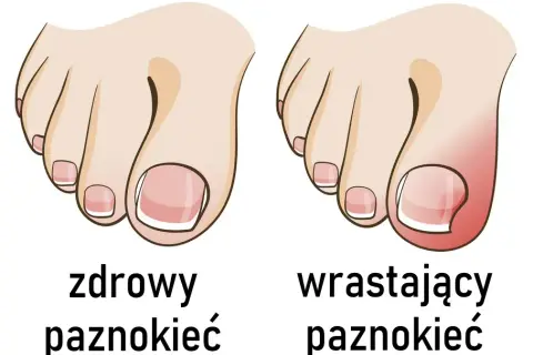 Jak prawidłowo obcinać paznokcie u stóp? Koniec z wrastaniem!