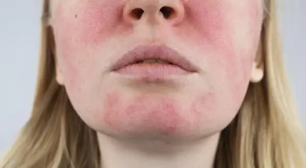 Czy kwas hialuronowy uczula? Prawdziwa alergia to mit! Sprawdź.