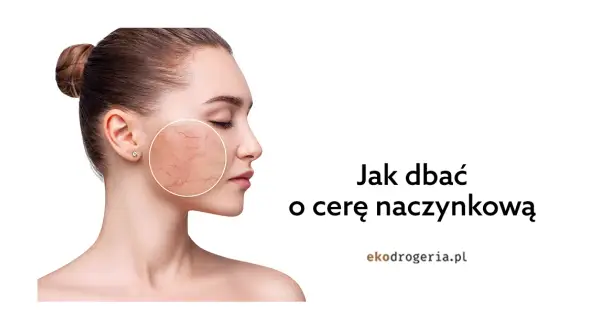 Jak dbać o cerę naczynkową? Skuteczne metody i porady eksperta