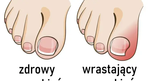 Jak prawidłowo obcinać paznokcie u stóp? Koniec z wrastaniem!
