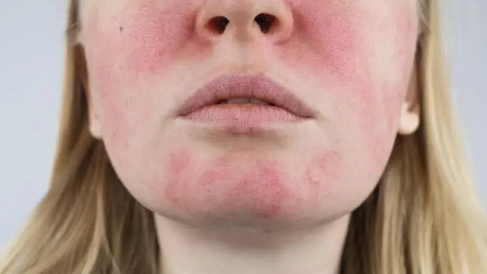 Czy kwas hialuronowy uczula? Prawdziwa alergia to mit! Sprawdź.