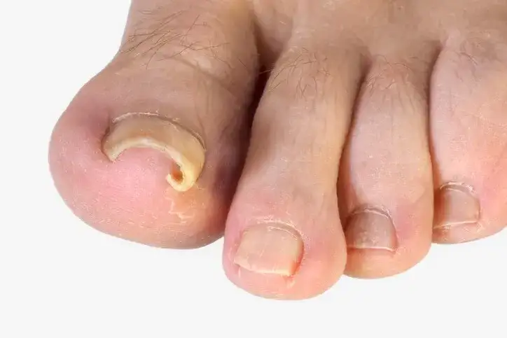 Wrastający paznokieć objawy