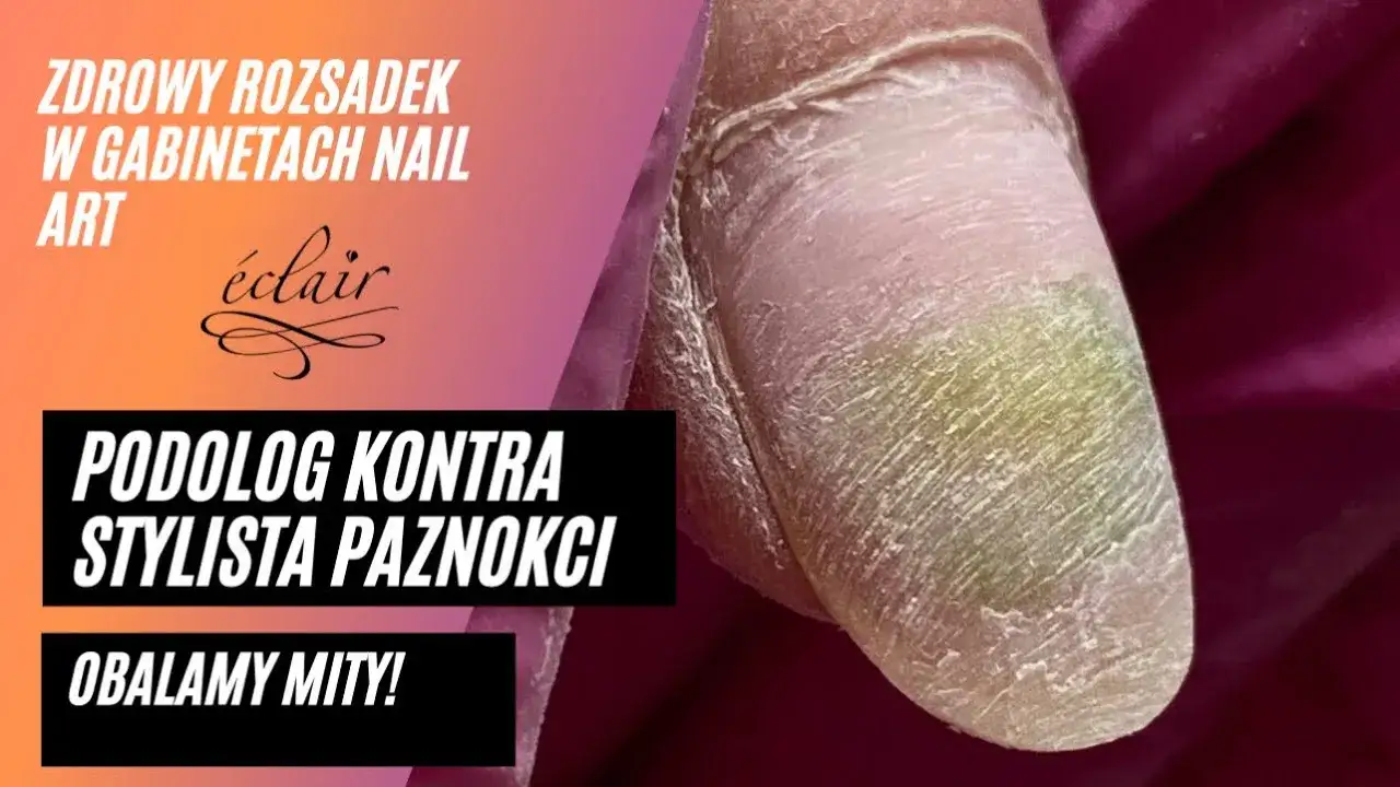 zielony paznokieć grzybica krwiak por&oacute;wnanie