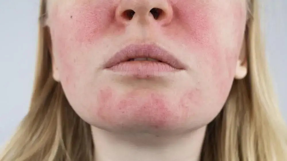 objawy po kwasie hialuronowym normalne a alergia