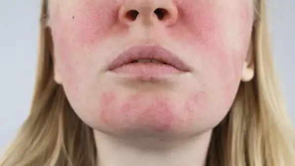 Czy kwas hialuronowy uczula? Prawdziwa alergia to mit! Sprawdź.