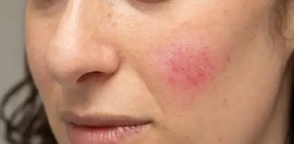 Cera naczynkowa: objawy, przyczyny, trądzik różowaty jak odróżnić?